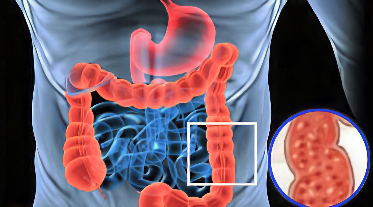 Viêm đại tràng uống kháng sinh dài ngày và hậu quả khó lường