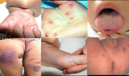 Bộ Y tế thông tin: 1 người tử vong do bệnh chân tay miệng, gần 400 người ngộ độc rượu