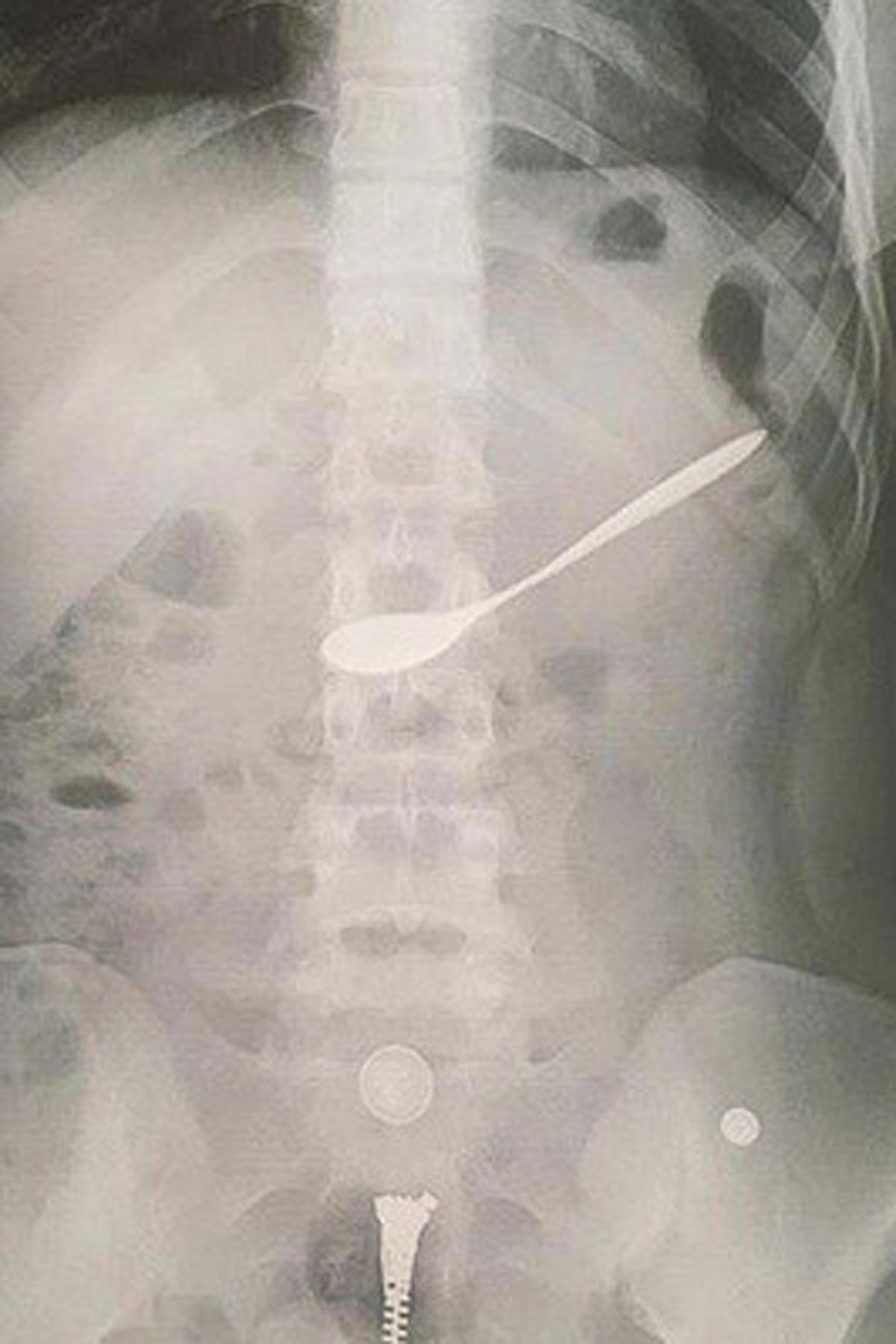 Cô gái trẻ vô tình nuốt chiếc thìa vào bụng