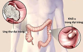 Những sự thật ít biết về ung thư đại trực tràng