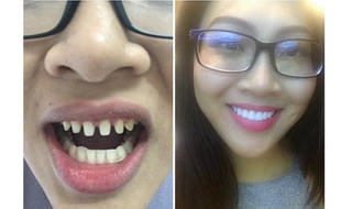 Ồn ào chuyện Đại diện Việt ở Hoa hậu Thế giới bị tố thẩm mỹ