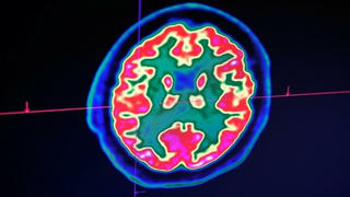 Virus corona cũng ảnh hưởng đến não?