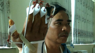 Gia Lai: Bắt gỗ lậu, kiểm lâm bị côn đồ chém đứt gân tay