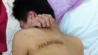 Hà Nội: Sinh viên bị nhóm côn đồ chém rách lưng vì va chạm xe máy