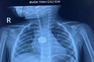 Cứu sống bé gái 3 tuổi nuốt phải pin cúc áo 