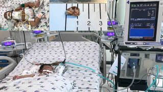 Cứu sống bé tràn mủ màng tim, màng phổi, viêm nội tâm mạch nặng