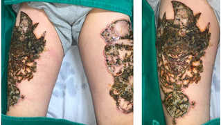Hai chân lở loét, chảy dịch sau khi xóa xăm
