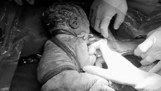 Cứu sống thai nhi bị dây rốn quấn 6 vòng cực kỳ nguy hiểm