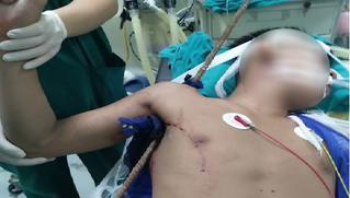 Né gạch rơi, nam thanh niên bị thanh sắt đâm xuyên thấu từ nách lên vai