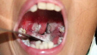 5 biện pháp cần thực hiện để phòng bệnh bạch hầu