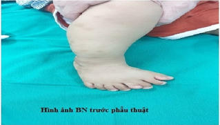 Bé trai 1 tuổi bị dị tật phức tạp, bàn chân phải có 9 ngón