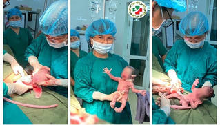 Cứu sản phụ sinh 3 cùng trứng hiếm gặp