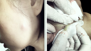 Nhập viện vì tiêm botox thu gọn mặt tại spa 
