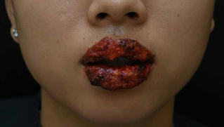 “Suýt” mất môi vì xăm giá rẻ 