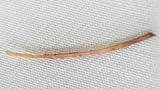 Xương cá dài 3cm đâm thủng ruột người