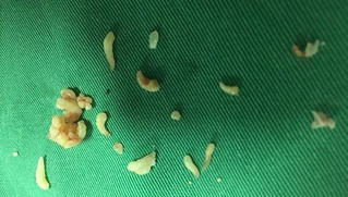 Lấy gần 20 chiếc răng trong khối u của bệnh nhi 12 tuổi