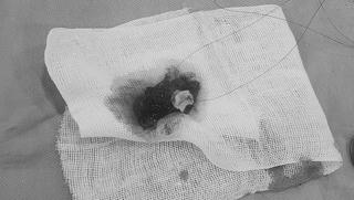 Người đàn ông phát hiện khối u hiếm gặp sau khi nhập viện vì hoa mắt, chóng mặt