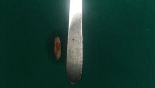 Răng mọc ngược, chọc thủng hốc mũi của một nam thanh niên