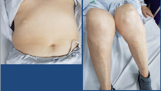 Hệ lụy khôn lường từ việc lạm dụng thuốc chứa corticoid