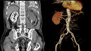Nhập viện vì đau dữ dội mạn sườn trái, phát hiện bị vỡ phình động mạch thận