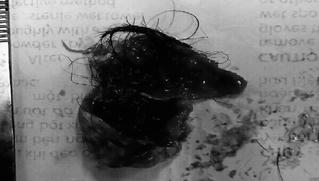 Người phụ nữ có khối u buồng trứng chứa đầy tóc và bã đậu