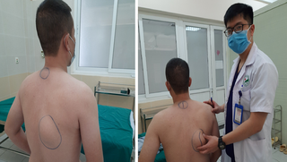 Phát hiện 2 khối u mỡ trên lưng người đàn ông nghiện rượu 