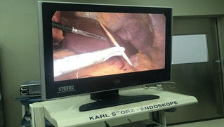 Thủng dạ dày vì thói quen vừa nằm vừa xỉa răng 