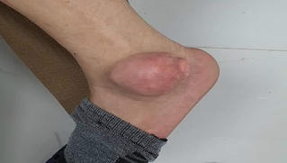 Chữa gout bằng thuốc trên mạng, bệnh nhân chân sưng to như quả ổi 