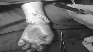 Nối thành công bàn tay trái bị đứt lìa cho nữ bệnh nhân