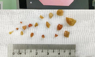 Hóc hạt lạc khiến 3 trẻ suy hô hấp nặng 