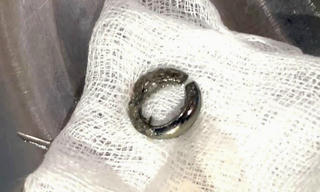 Bé trai 27 tháng tuổi nuốt móc khoá 