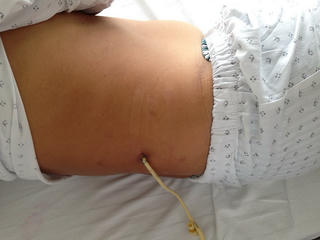 Bệnh viện Đại học Y dược Shing Mark điều trị thành công ca sỏi thận bằng kỹ thuật cao