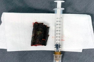 Gắp dị vật khó ở hốc mắt bệnh nhân 32 tuổi