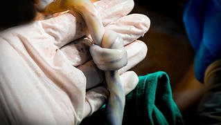 Mẹ con sản phụ bị thắt nút dây rốn hiếm gặp