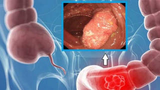 Chuyên gia mách 5 bệnh ung thư có thể phát hiện sớm ngay tại nhà