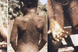 Xuất hiện ca mắc đậu mùa khỉ tại Đồng Nai