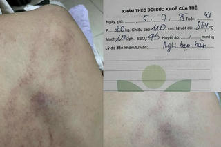 Vụ nghi trẻ bị bạo hành tại Trường mầm non Gia Thụy (Hà Nội): Đã trưng cầu giám định và đang chờ kết quả