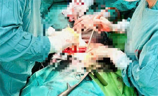 Phẫu thuật, loại bỏ u xơ tử cung có kích thước lớn hiếm gặp cho một bệnh nhân 