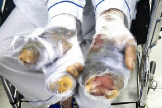 Cụ bà bị chó nhà cắn nát 2 bàn tay