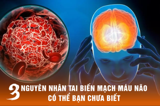 3 nguyên nhân tai biến mạch máu não có thể bạn chưa biết