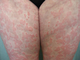 Ngứa da mùa lạnh ở người cao tuổi: Khi làn da kêu cứu!