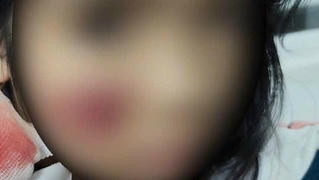 Khỉ hoang tấn công trẻ nhỏ, gây vết thương phức tạp vùng mặt và đầu