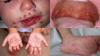 Bộ Y tế chỉ đạo xử lý các ổ dịch sốt xuất huyết, chân tay miệng tại TP. Hồ Chí Minh