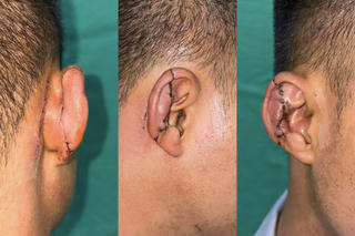 Cứu thành công vành tai gần đứt rời của bệnh nhân bị tai nạn giao thông