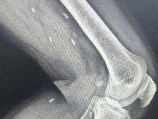 Một bệnh nhân tại Quảng Trị có nhiều kén sán ở chân