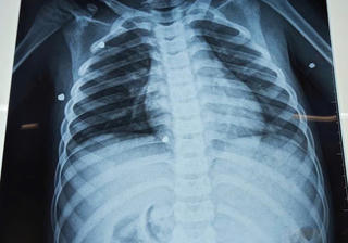 Bé trai 6 tuổi bị đa chấn thương nghiêm trọng do nghịch súng hơi