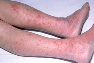 Triển khai các biện pháp phòng dịch bệnh viêm màng não mô cầu 