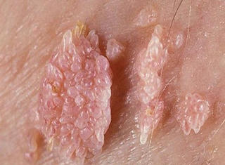 Cụ ông 70 tuổi mắc sùi mào gà sau lần quan hệ tình dục không an toàn