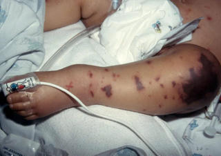 Sở Y tế An Giang tăng cường triển khai các biện pháp phòng bệnh viêm não mô cầu