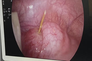 Kịp thời cứu bệnh nhân nuốt tăm tre đâm thủng manh tràng tại Đồng Tháp